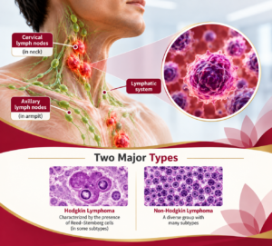 Lymphoma-Cancer